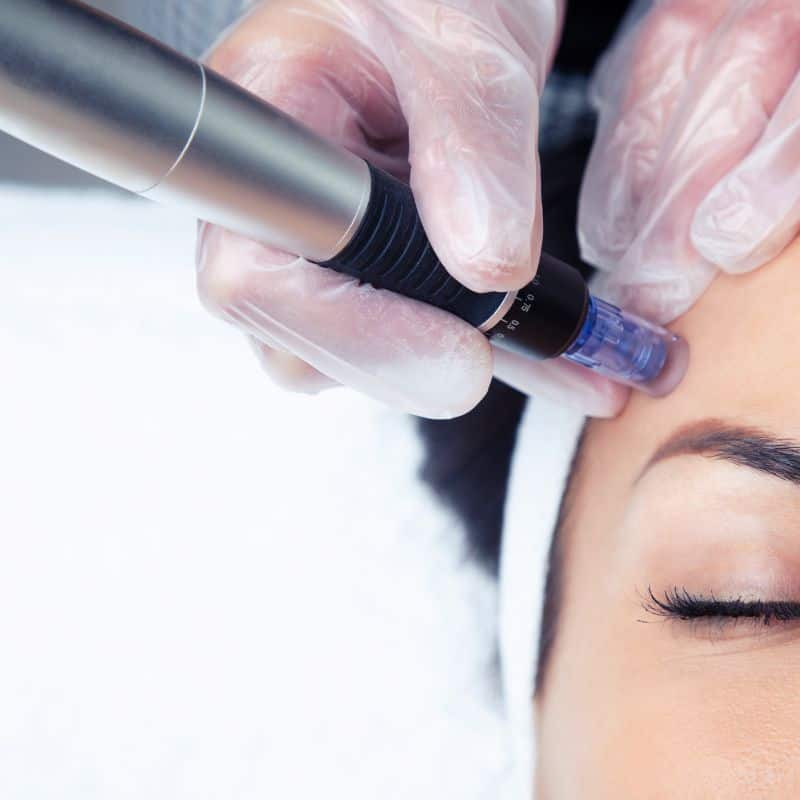 Morpheus8 treatment Wisbech from Lipo Sculpt - Book in today!